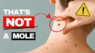 5 Mole IMPOSTERS that most people get WRONG