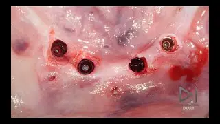 dr.Giampiero Ciabattoni Digital Implantology Video Channel