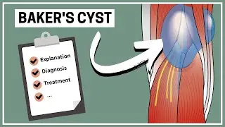 What is a Baker's cyst (Explanation, Diagnosis and Treatment)