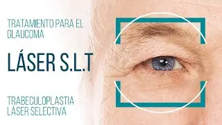 TRATAMIENTO DEL GLAUCOMA CON LASER SLT