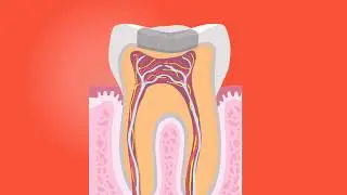 HOW A ROOT CANAL IS DONE ~ ANIMATION