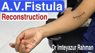 Arteriovenous fistula, fistula reconstruction, Acute & chronic renal failure, kidney transplant