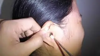 Removing Different Kinds of Foreign Bodies Stuck In People's Ears- What's Your Pick?