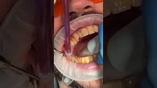 Ультразвуковая чистка зубов