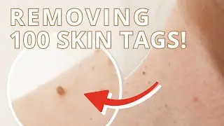 100 Skin Tags Removed from My Neck – 2 Weeks Before & After ft. Q Esthetics