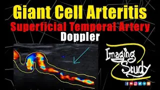 Giant Cell Arteritis || Superficial Temporal Artery Doppler || Ultrasound || Case 243