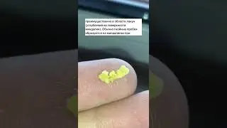 Белые желтые комочки из горла гланд. Тонзиллит. 