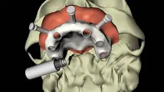 Computer Guided Dental Implant Tooth Replacement at ORA Oral Surgery & Implant Studio