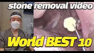 World BEST 10 Tonsil stone removal video (편도결석 베스트 10)