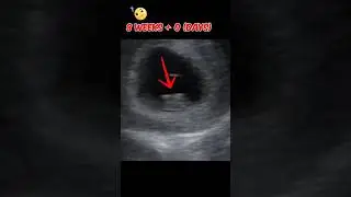8 weeks+ 0 days |  baby 🐥 | ultrasound #baby #pregnancy #shorts