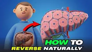 How to Reverse Fatty Liver Disease Before It’s Too Late