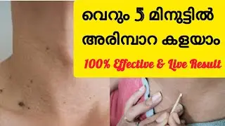 അരിമ്പാറ കളയാം 5 മിനുട്ടിനുള്ളിൽ || Arimpara Removal || Malayalam