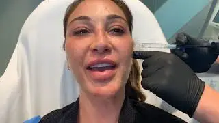I GOT FILLERS TO RESHAPE MY FACE | FEMALE FACIAL SCULPTING | Dr. Jason Emer