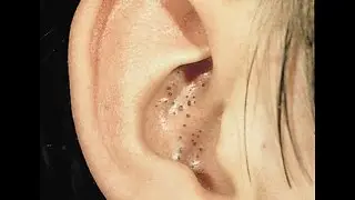 Черные точки народные методы