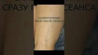 СКЛЕРОТЕРАПИЯ