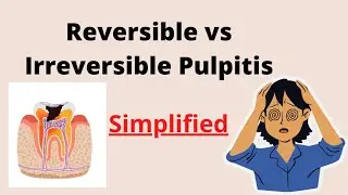 Reversible vs Irreversible Pulpitis