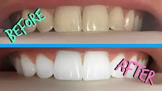 Whiten Your Teeth Naturally. Guaranteed Result