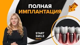 Полная имплантация зубов: диагностика, лечение, цена