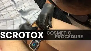 Scrotox Cosmetic Procedure
