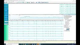 Сравнение начальной фазы QRS - аспект сравнения формы.