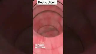 peptic ulcer disease 