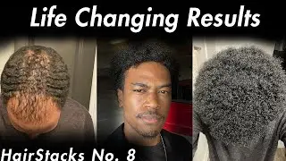He Got The Best Hair Transplant | HairStacks Podcast No. 8