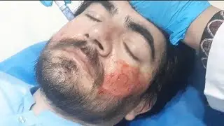 Face PRP+Micro Needling 3D life style in peshawar