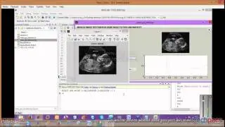 Ultrasound image noise reduction | Speckle noise removal  (latest Project 2020)