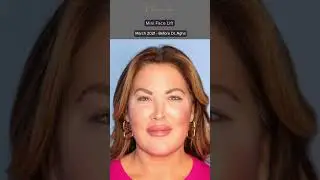 Mini Facelift Before & After: Emily Simpson, Real Housewife of Orange County