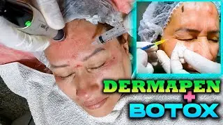 DERMAPEN + TOXINA BOTULÍNICA 🔥 Lo mejor para ARRUGAS FACIALES?✅ CURSO GRATIS 💪👨‍⚕