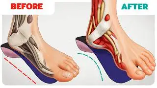 The Right Way to Use Toe Spacers & Arch Support