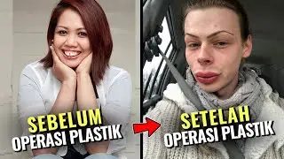 Not What We Expected! These Indonesian Artists Had Botched Plastic Surgery