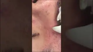 Lumps of Sebums Removed from the Face