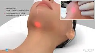 ENDOLIFT® | Antiaging Lifting - Laser Tightening Skin | Ringiovanimento Viso con Laser [Eufoton®]