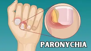 Paronychia - Causes, Risk Factors, Signs & Symptoms, Treatment - Everything You Need To Know