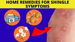 Home Remedies For Shingle Symptoms | Think Good