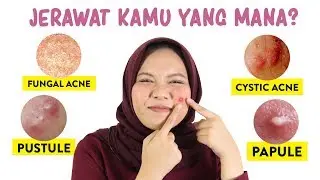 Jenis Jerawat dan Cara Mengatasinya | Skincare101