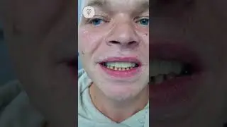 Красивые, ровные и белые зубы. Что было ДО смотрите по ссылке на экране. Имплантация зубов.