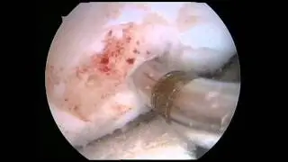 Implante meniscal y cartifill