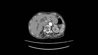 Klatskin tumor