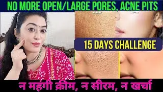 टमाटर में ये एक चीज मिलाकर लगा लेना, OPEN PORES, चेहरे के गड्ढे ऐसे गायब होंगे जैसे कभी थे ही नहीं