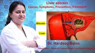 Liver abscess | लिवर एब्सेस रोग क्या है | यकृत फोड़ा | Dr Hardeep Bains