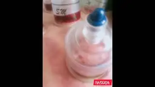 Prat# 2 Penjelasan singkat tentang bekam