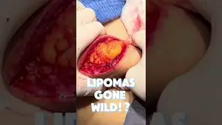 LIPOMAS GONE WILD