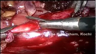 Laparoscopic salvage ureterocalicostomy for failed robotic assisted pyeloplasty by Dr George P Abrah