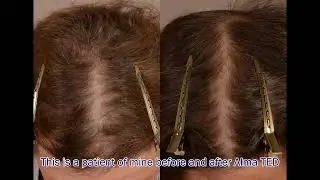 Non-Surgical Hair Loss Treatment With Alma TED - This Week at Haber Dermatology