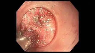 Management of ESD related complications