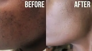 Get Rid of Acne &  Hyperpigmentation (Dark Spots)