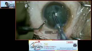 KSOS2023   GP30  Topic Dr Prabhu Shanker M  Posterior Polar Cataract