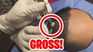 DISGUSTING Moments from Dr. Pimple Popper that MADE US SHUDDER!